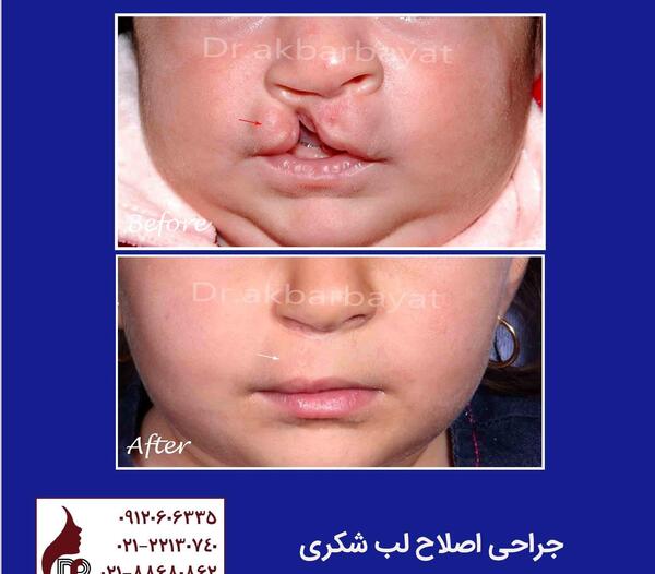 عکس لب شکری بعد از عمل