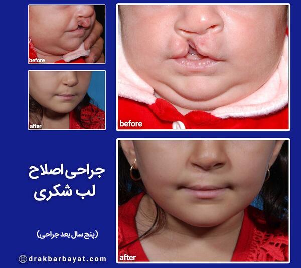 عکس لب شکری بعد از عمل