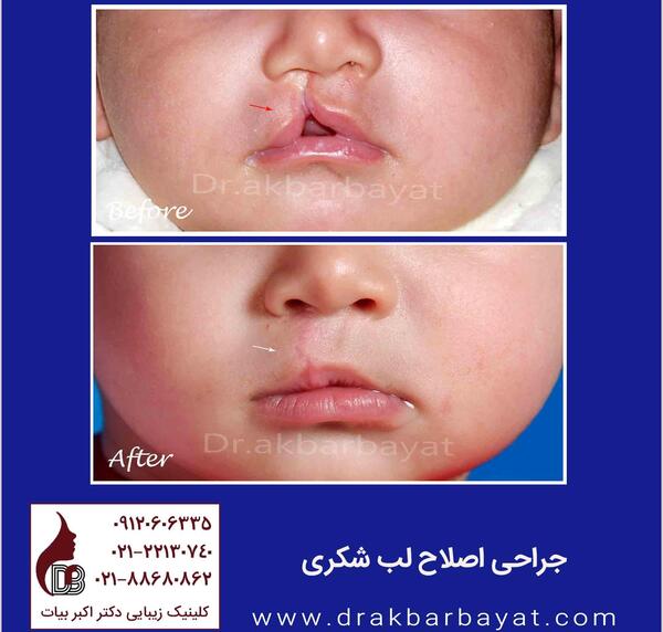 عکس لب شکری بعد از عمل