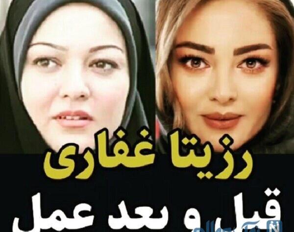 عکس رزیتا غفاری بعد از عمل