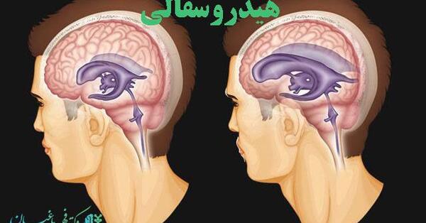 عکس ام ار ای هیدروسفالی