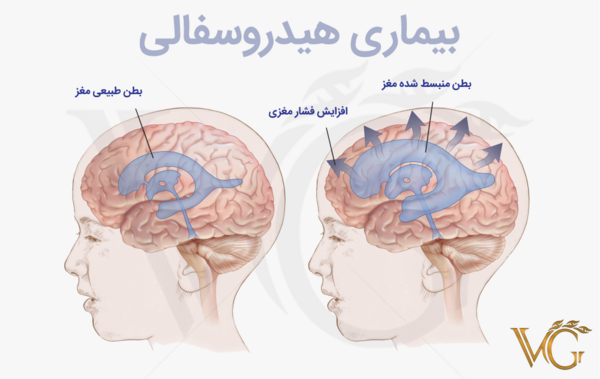 عکس ام ار ای هیدروسفالی