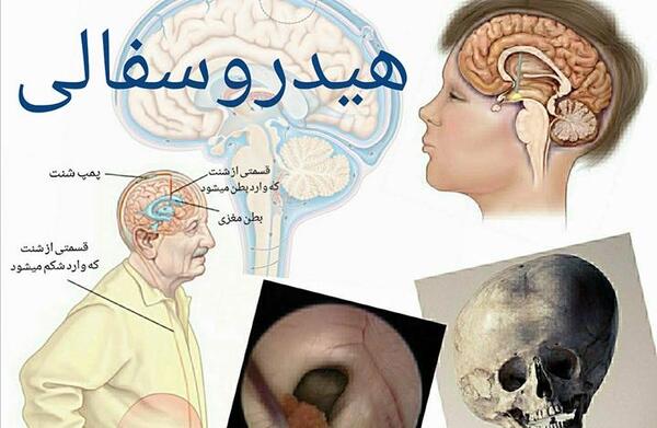 عکس ام ار ای هیدروسفالی