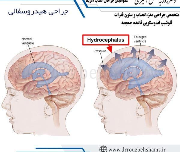 عکس ام ار ای هیدروسفالی