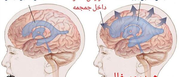 عکس ام ار ای هیدروسفالی