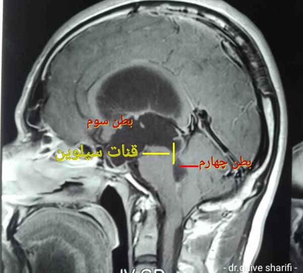 عکس ام ار ای هیدروسفالی