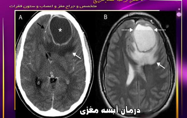 عکس ام ار ای هیدروسفالی