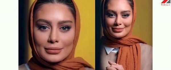عکس امیرحسین آرمان قبل از عمل بینی