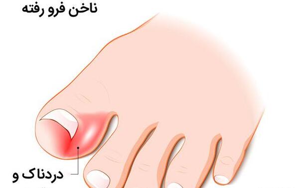 عکس ناخن چرکی