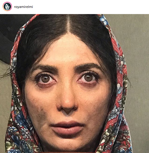 عکس رویا میرعلمی قبل از عمل بینی