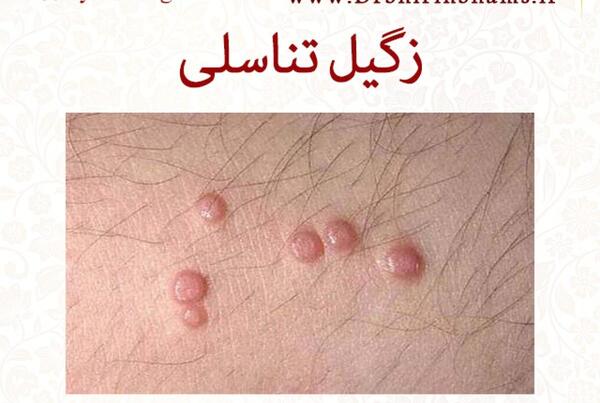 عکس زگیل نی نی سایت