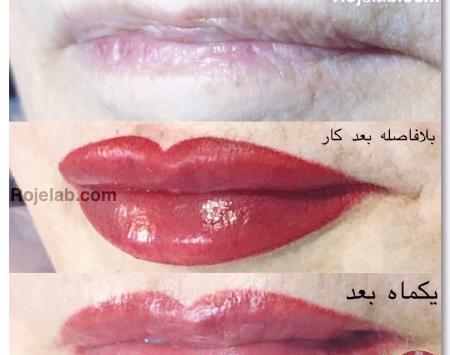 عکس کاشت لب