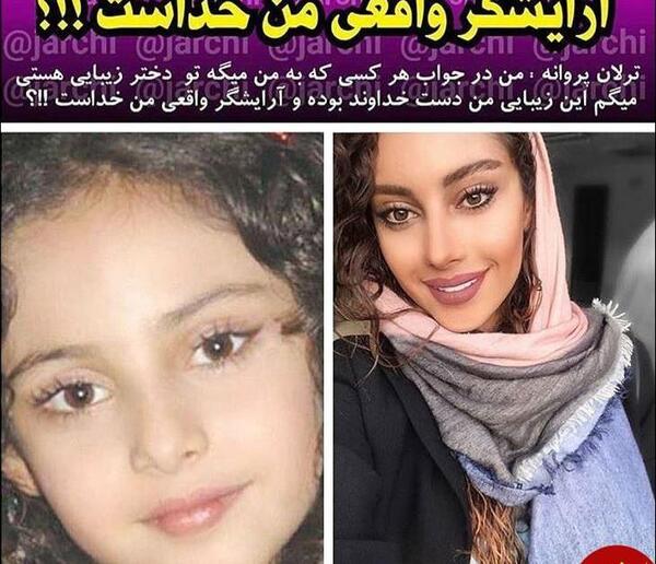 عکس ترلان پروانه بعد از عمل زیبایی