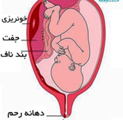 عکس واقعی خونریزی لانه گزینی