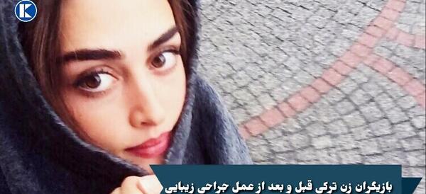 عکس زلیخا قبل از عمل