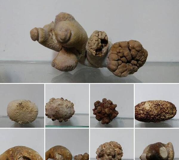 عکس سنگ کلیه سیاه رنگ