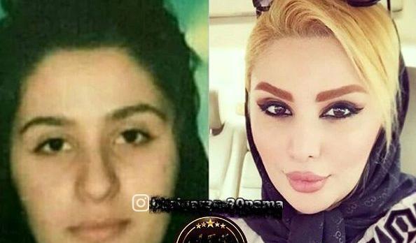 عکسهای اشکان اشتیاق قبل از عمل بینی