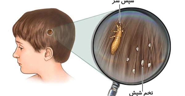 عکس شپش خیلی ریز