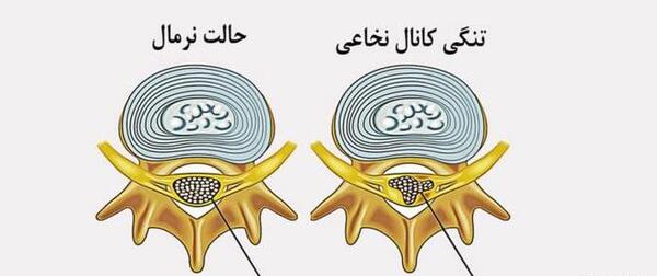 عکس ام ار ای تنگی کانال نخاعی