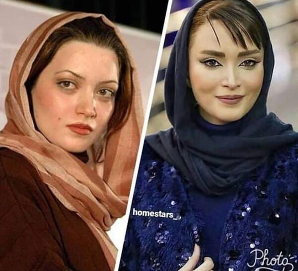عکس بهنوش بختیاری قبل و بعد از عمل زیبایی