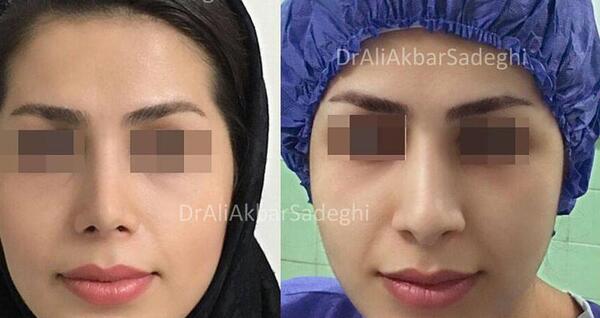 عکس علی صادقی قبل از عمل