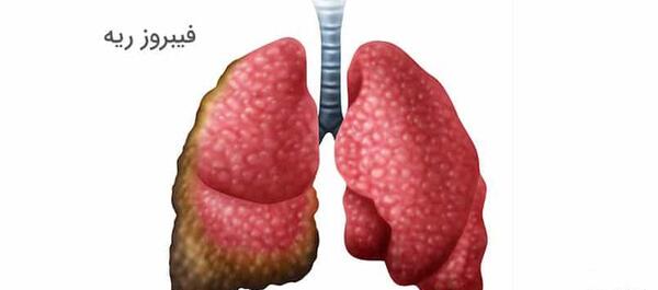 عکس ریه فیبروز شده