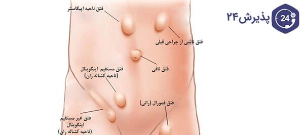 عکس فتق در نوزاد دختر