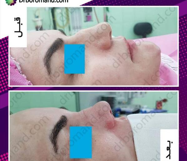عکس قبل بعد