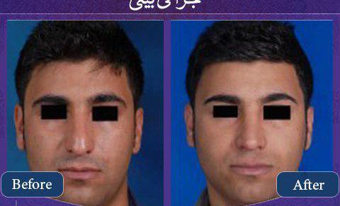 عکس قبل بعد