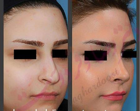 عکس شادمهر عقیلی قبل از عمل بینی