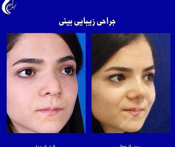 عکس حمیرا ریاضی قبل از عمل بینی