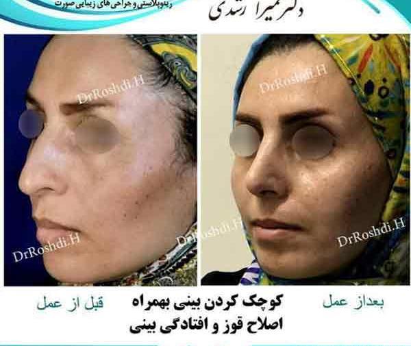 عکس حمیرا ریاضی قبل از عمل بینی