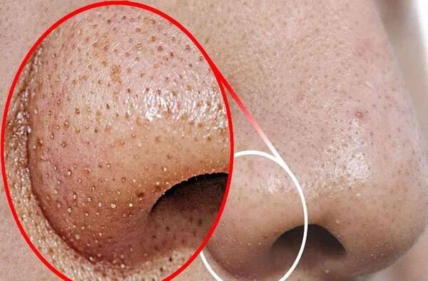 عکس دانه های سیاه روی بینی