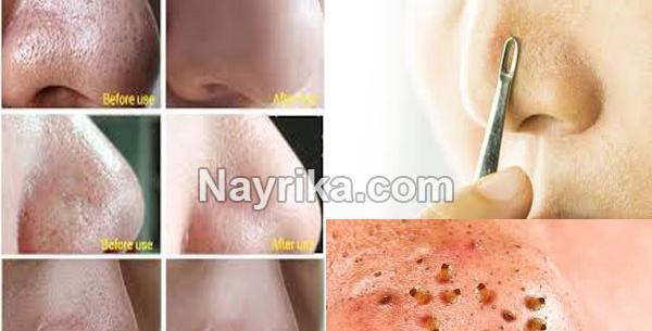 عکس دانه های سیاه روی بینی