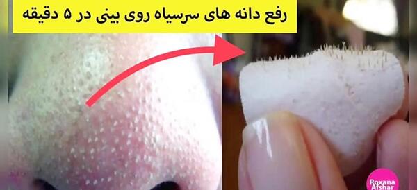 عکس دانه های سیاه روی بینی