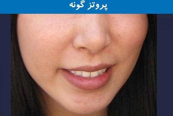 عکس کاشت گونه