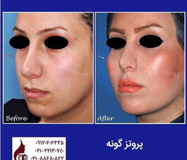عکس کاشت گونه