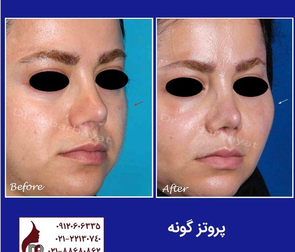 عکس کاشت گونه
