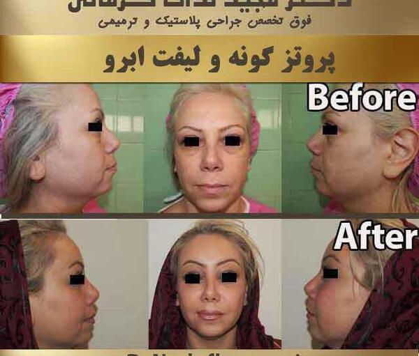 عکس کاشت گونه