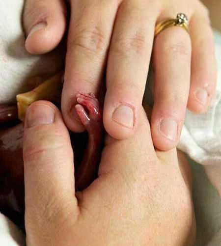عکس جنین یک ماهه سقط شده