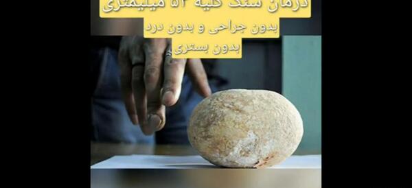 عکس سنگ کلیه 3 میلیمتری