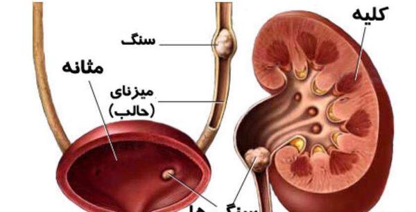 عکس سنگ کلیه 3 میلیمتری