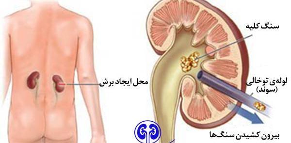 عکس سنگ کلیه 3 میلیمتری