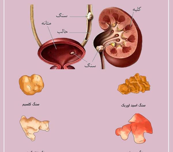 عکس سنگ کلیه 3 میلیمتری