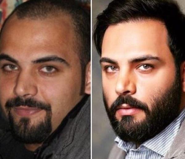 عکس برزو ارجمند قبل و بعد از کاشت مو