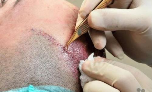 عکس برزو ارجمند قبل و بعد از کاشت مو