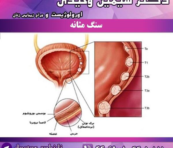 عکس سنگ مثانه