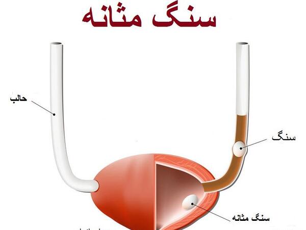 عکس سنگ مثانه