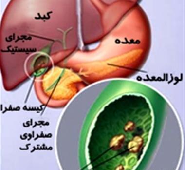 عکس سنگ صفرا در بدن