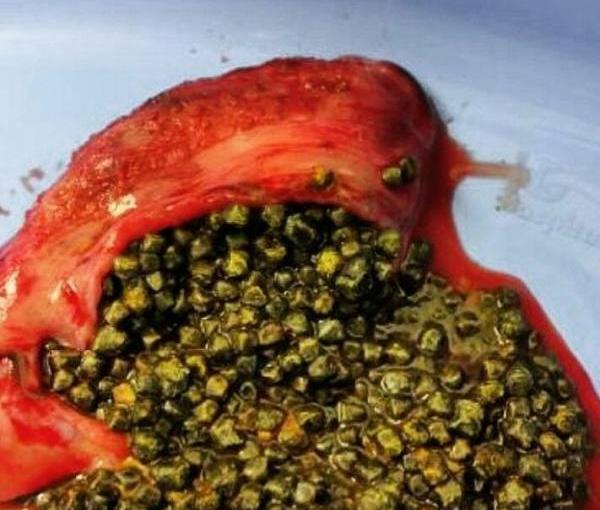 عکس سنگ صفرا در بدن